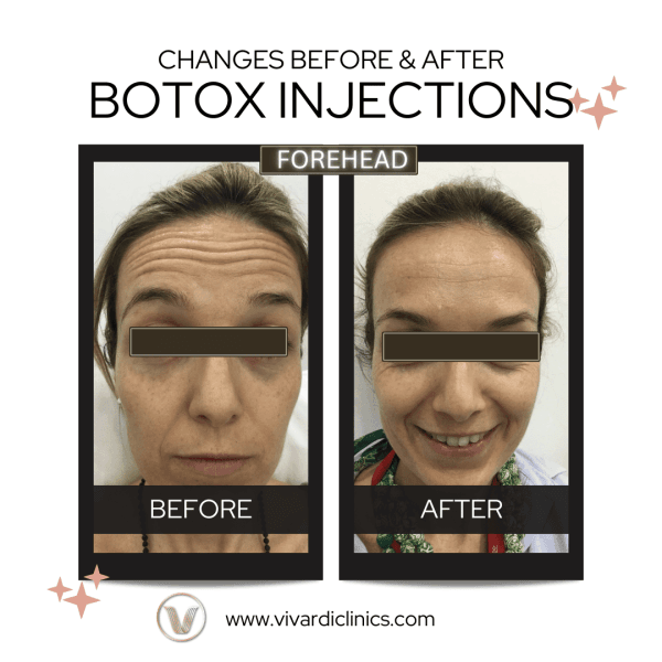 Botox injections 3