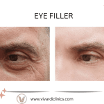 Eye Filler