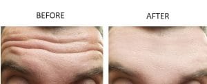 Anti-Wrinkle Treatments