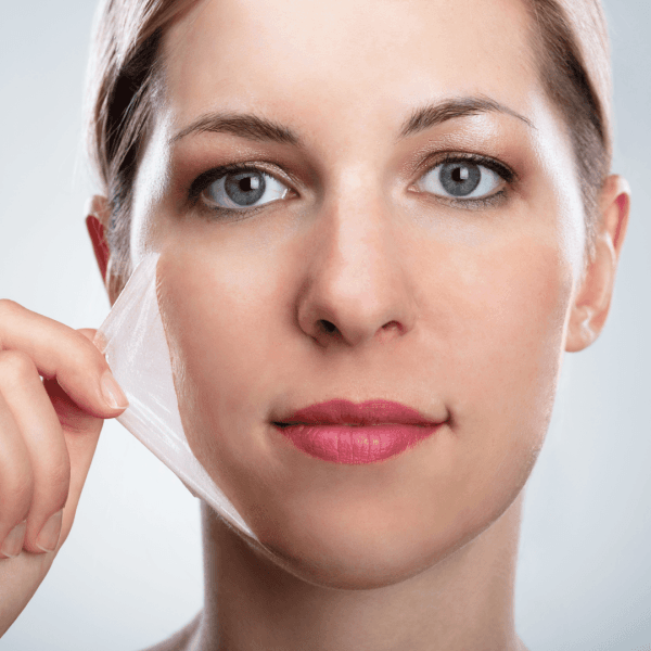 chemicalpeel