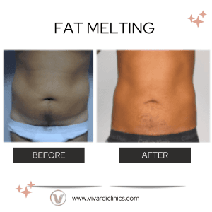 Fat Melting 300x300