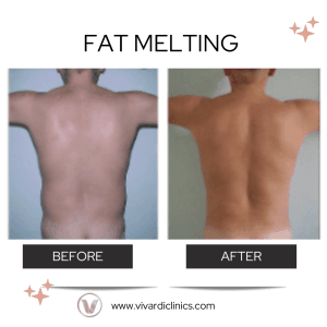 Fat Melting 2 300x300
