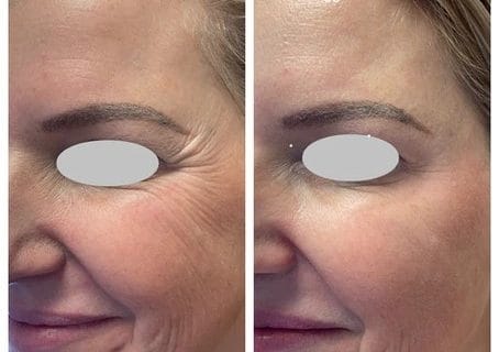 Common Areas Treated With Wrinkle Relaxers