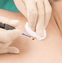 Kaedah Pembedahan Radiofrequency Paling Efektif Dalam Satu Sesi Sahaja