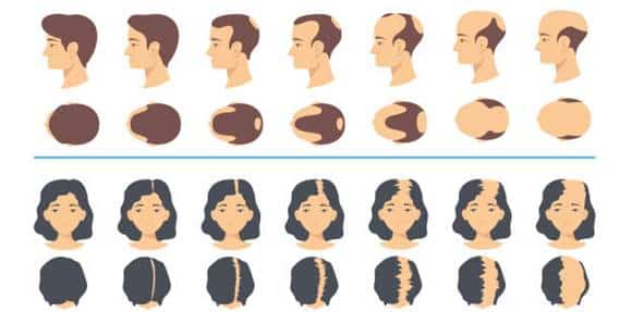 Empowering You Through Hair Restoration