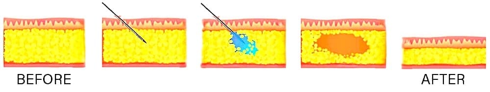 Say Goodbye To Fat With Mesolipolysis