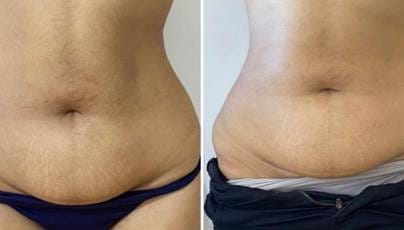 Aqualyx Fat Dissolving Injections In London Harley Street
