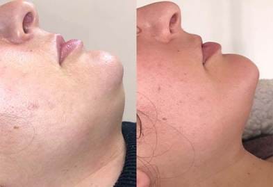 How To Remove Body Fat Without Liposuction Or Surgery?