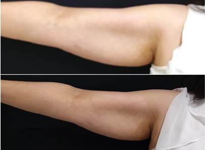 How To Remove Body Fat Without Liposuction Or Surgery?