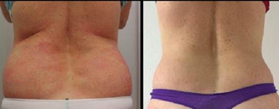 How To Remove Body Fat Without Liposuction Or Surgery?