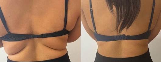 How To Remove Body Fat Without Liposuction Or Surgery?