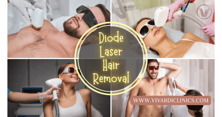 diode laser hair removal