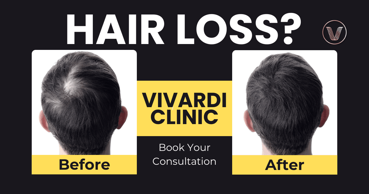 male hair loss treatment malaysia vivardi clinic selangor (1)