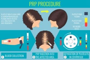 prp procedure