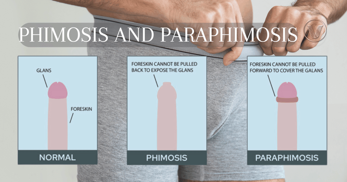 phimosis and paraphimosis