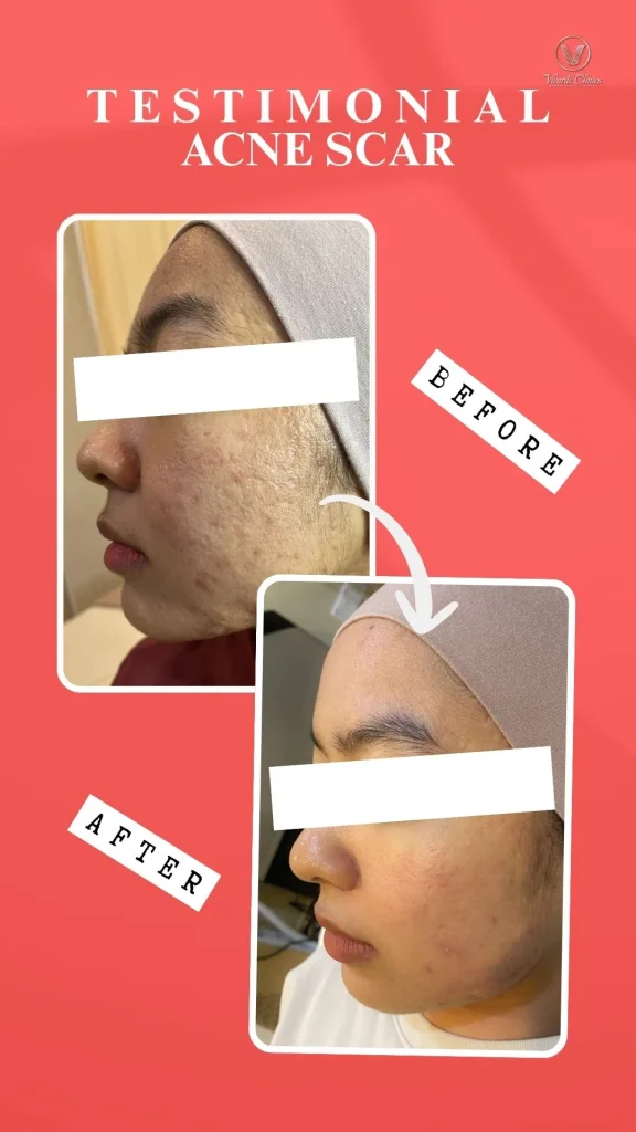 Before and after acne scar treatment at Vivardi Clinics Rawang