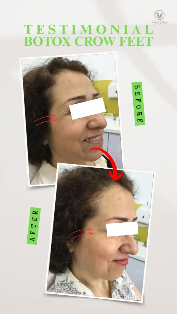 Before and after Botox treatment for crow's feet at Vivardi Clinics Rawang