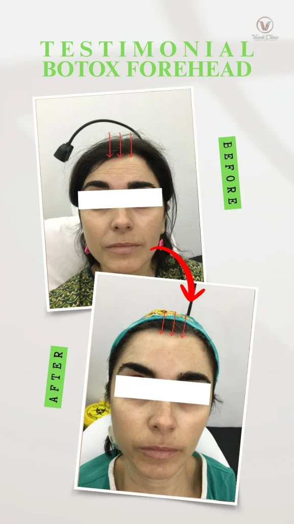 Before and after Botox treatment for forehead lines at Vivardi Clinics Rawang