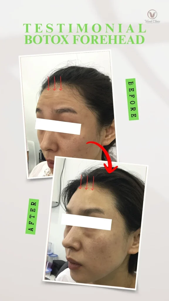 Before and after Botox treatment for forehead lines at Vivardi Clinics Rawang