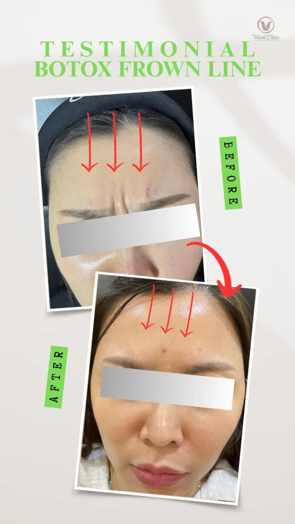 Before and after Botox anti-wrinkle treatment for frown lines at Vivardi Clinics Rawang