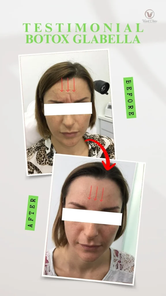 Before and after Botox treatment for glabella frown lines at Vivardi Clinics Rawang