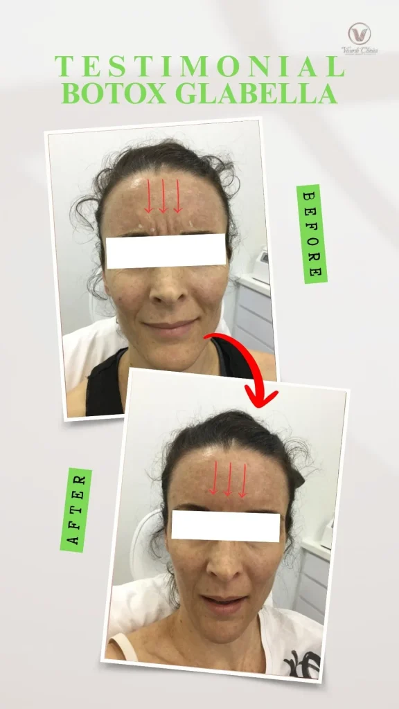 Before and after Botox treatment for glabella frown lines at Vivardi Clinics Rawang