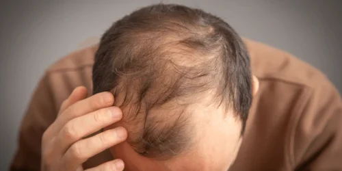 Caucasian man hair loss problem 600nw