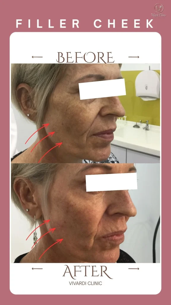 Before and after dermal filler for cheek volume at Vivardi Clinics Rawang