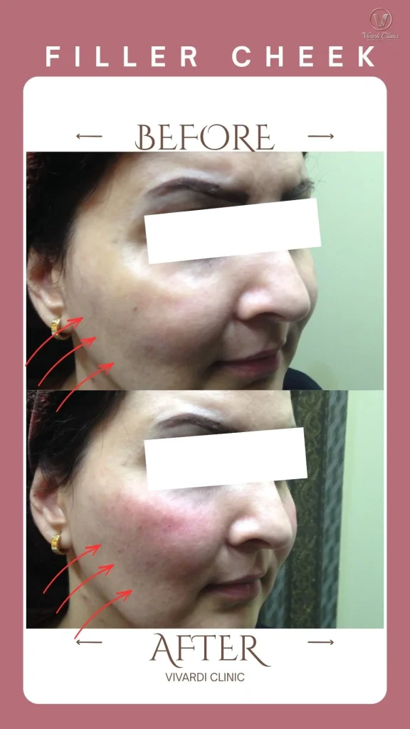 Before and after dermal filler for cheek volume at Vivardi Clinics Rawang