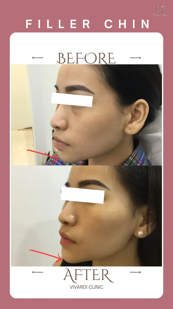 Before and after dermal filler for chin enhancement at Vivardi Clinics Rawang