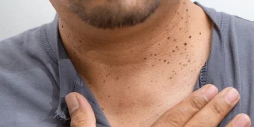 Closed skin tags acrochordon on neck 600nw