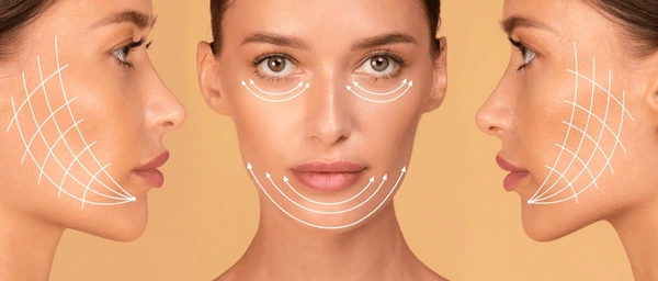 Thread Lift