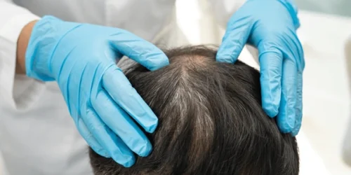 rawatan rambut gugur Selangor