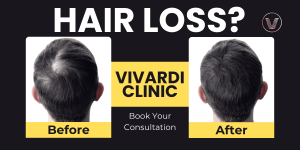 male hair loss treatment malaysia vivardi clinic selangor (1)