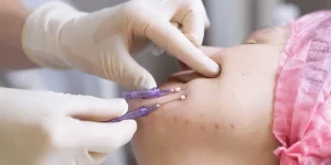 Aged woman doing mesothreads thread lifting 600nw