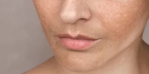 Close caucasian womans face freckles age 600nw