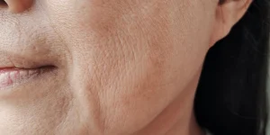 Portrait showing flabbiness adipose hanging beside 600nw