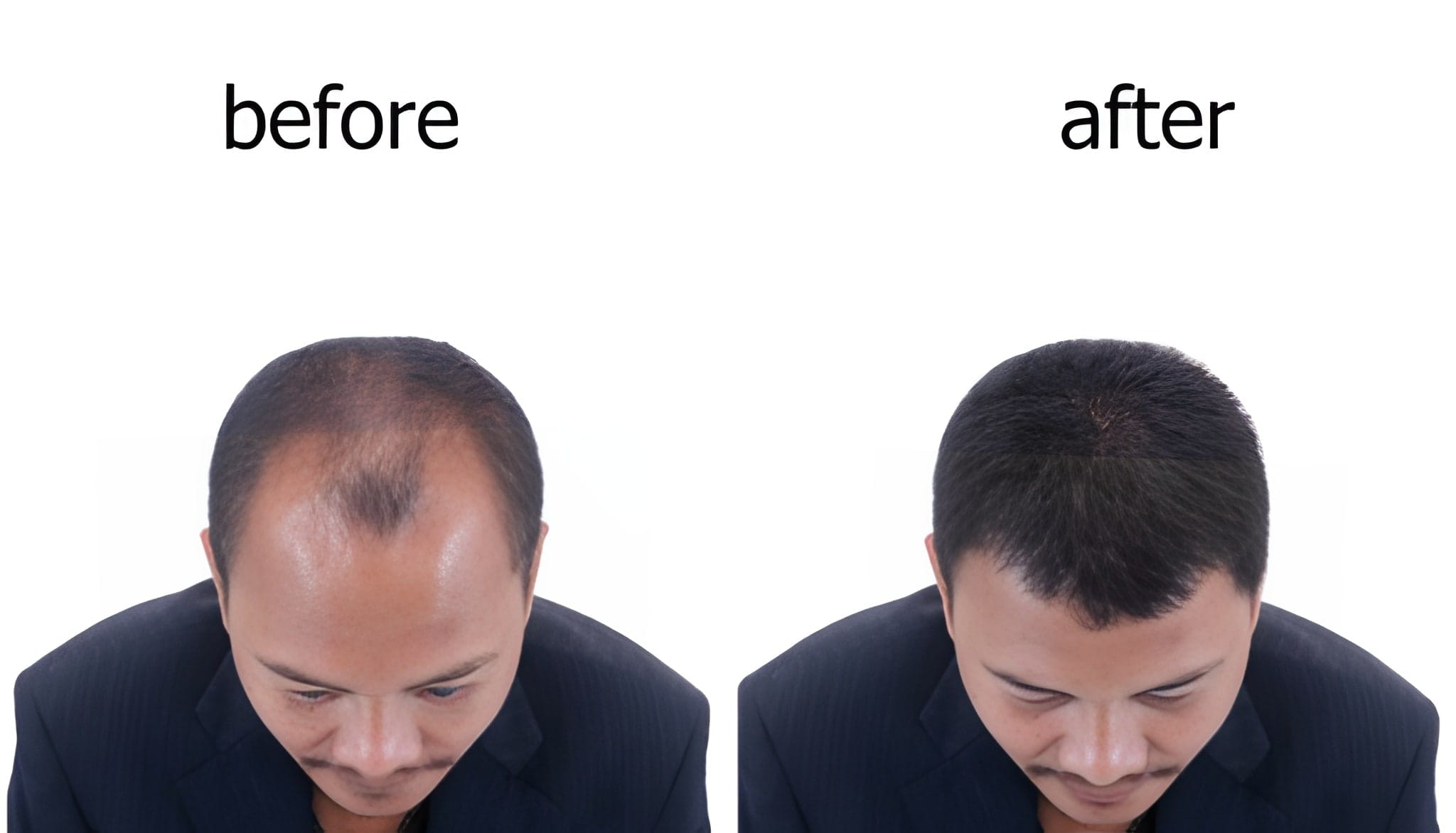 QR678 Neo Hair Loss Treatment