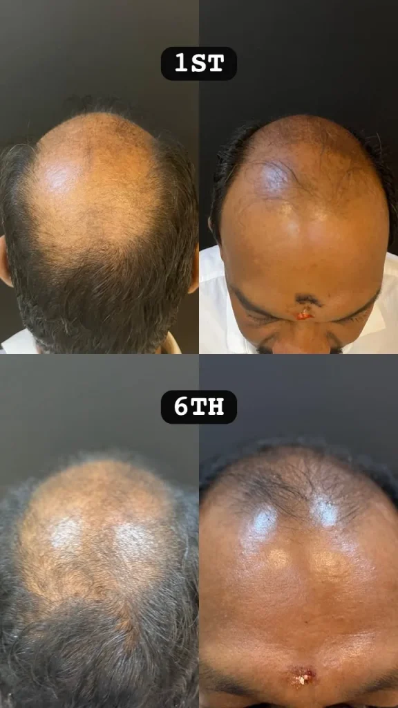 Hair regrowth progress from 1st to 6th session of hair loss treatment at Vivardi Clinics Rawang