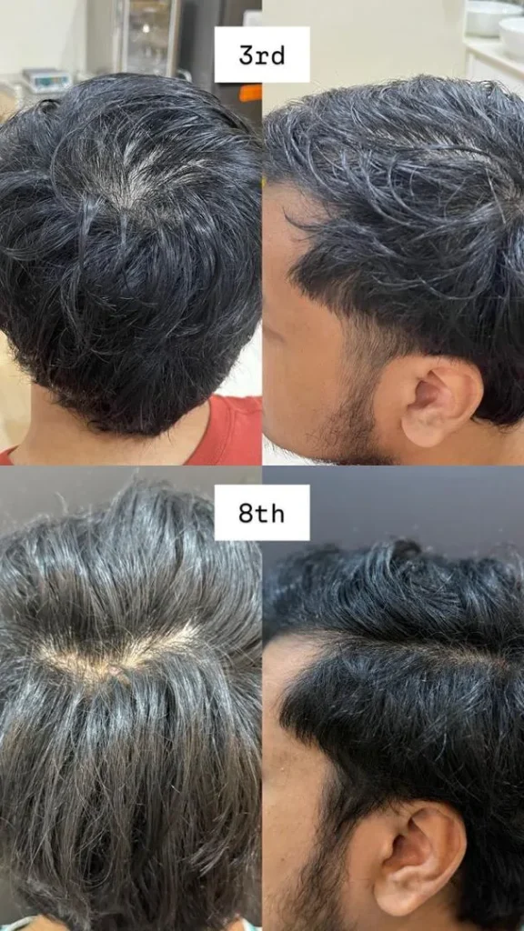 Before and after hair loss treatment progress at Vivardi Clinics Rawang