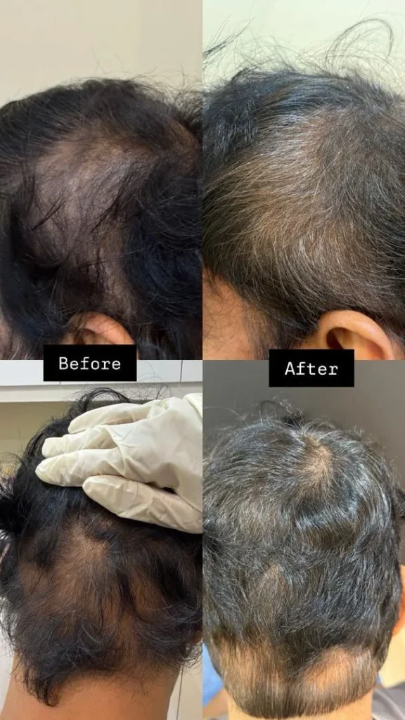 Before and after hair loss treatment progress at Vivardi Clinics Rawang