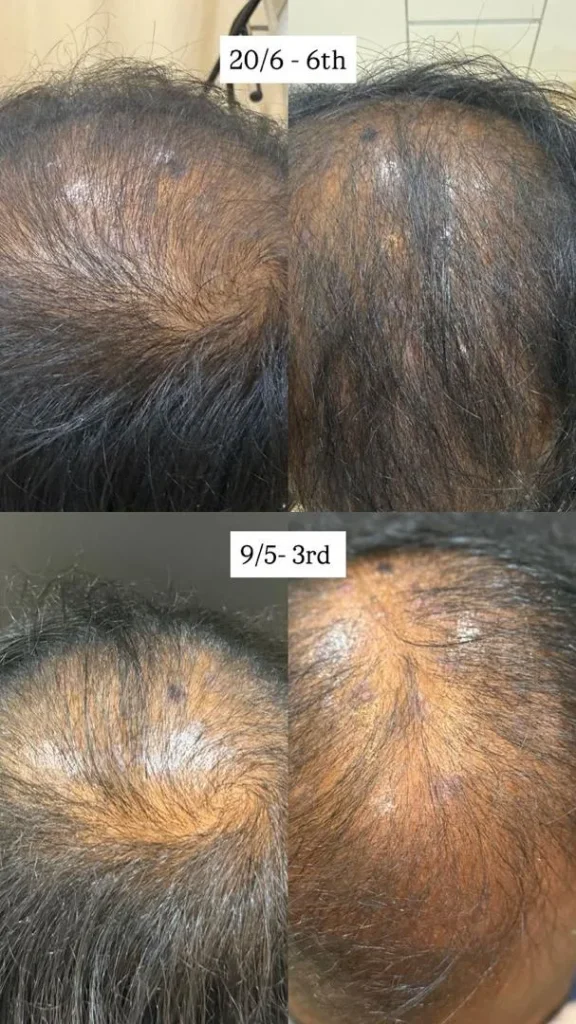 Before and after hair loss treatment progress at Vivardi Clinics Rawang