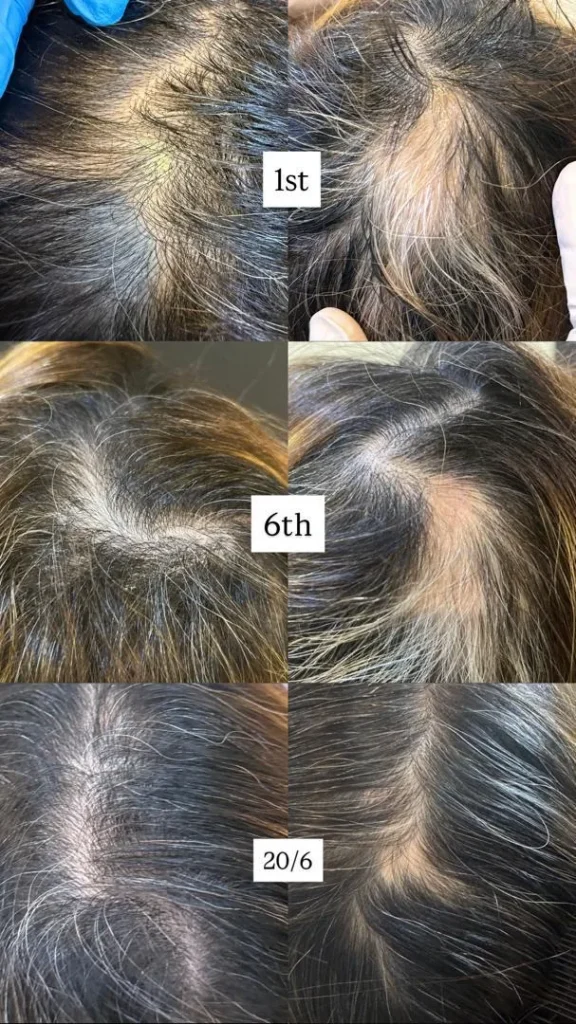 Before and after hair loss treatment progress at Vivardi Clinics Rawang