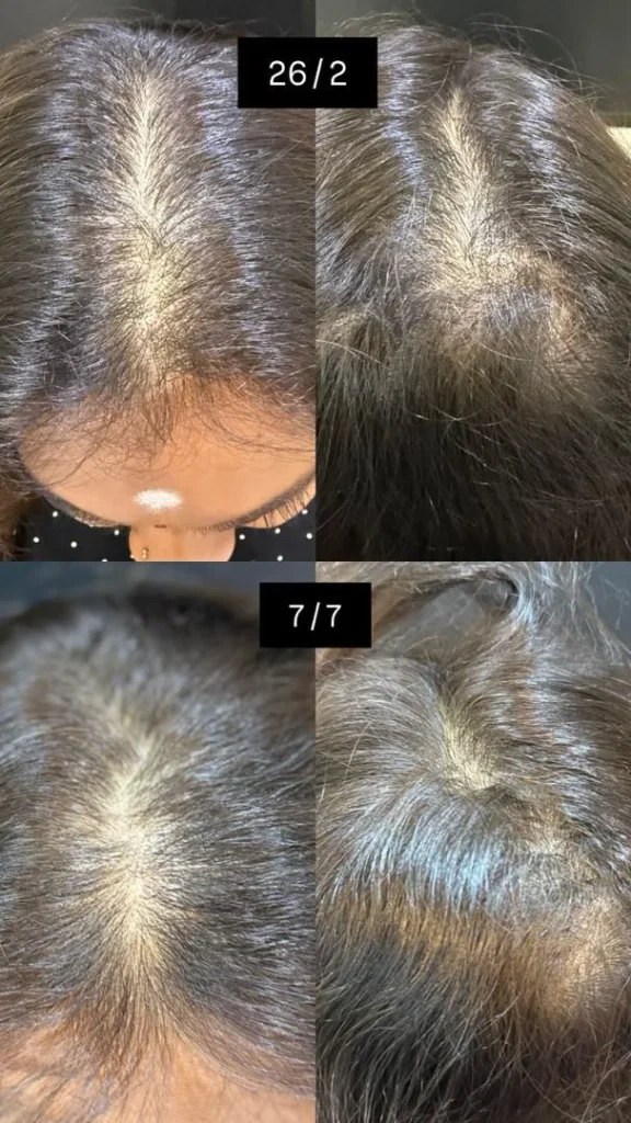 Before and after hair loss treatment progress at Vivardi Clinics Rawang