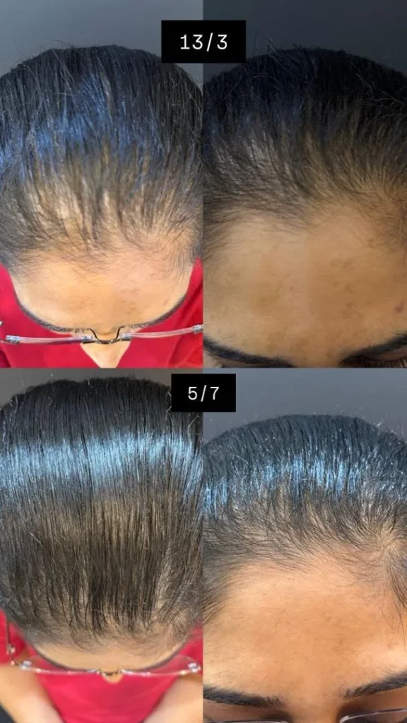 Before and after hair loss treatment progress at Vivardi Clinics Rawang