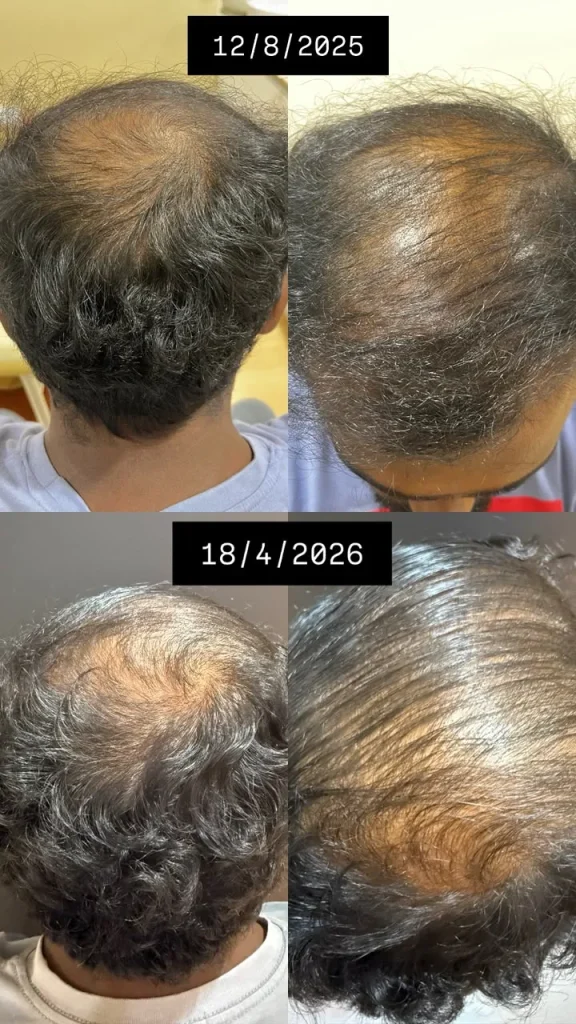 Before and after hair loss treatment progress at Vivardi Clinics Rawang