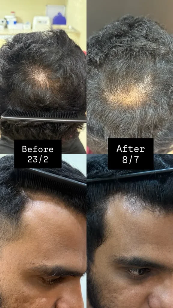 Before and after hair loss treatment progress at Vivardi Clinics Rawang