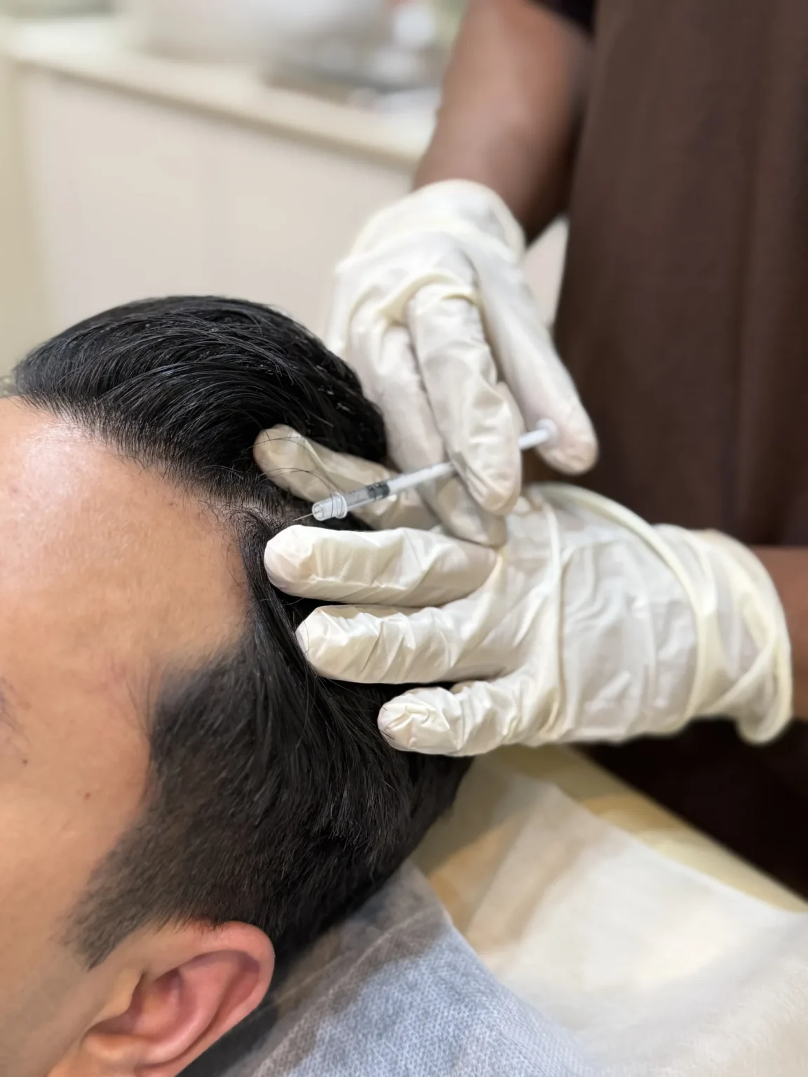Gloved doctor administering a scalp injection for hair restoration at Vivardi Clinics