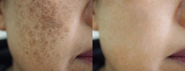 Image before after spot melasma pigmentation 600nw