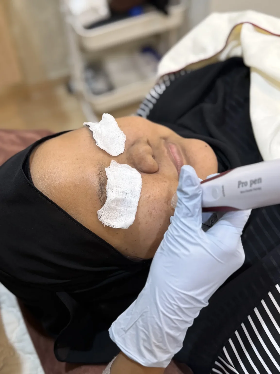 Microneedling facial treatment with a pen device on a woman at Vivardi Clinics Rawang